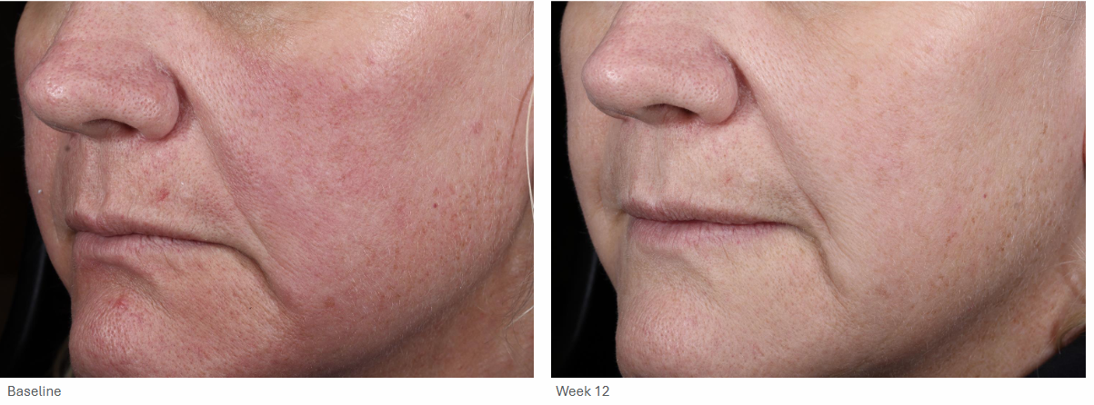 Chin before and after