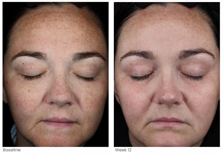 Dark spots before and after