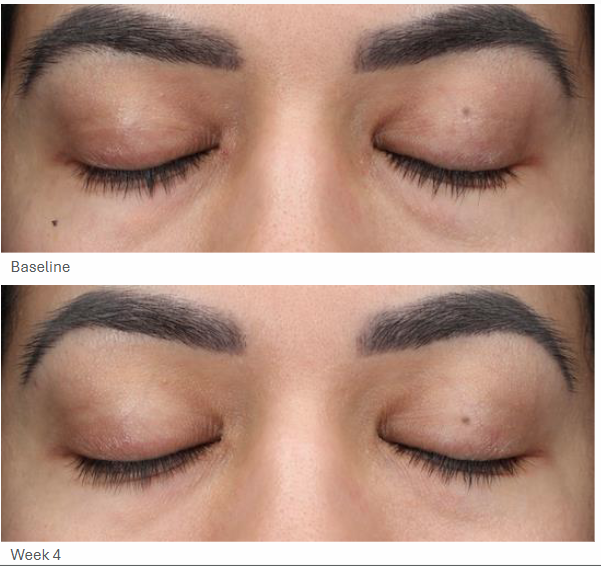 Eye before and after