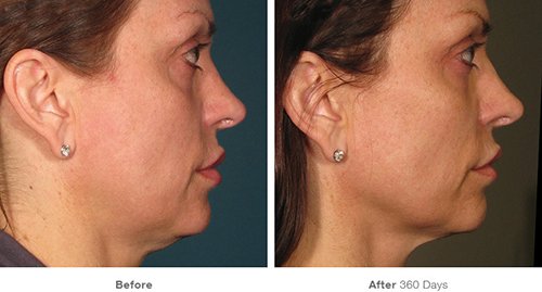 Ultherapy Patient Before and After Results