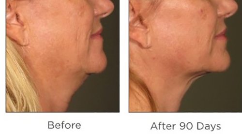 Ultherapy Patient Before and After Results