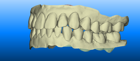 3-d scan of teeth