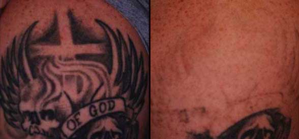 Laser Tattoo Removal  Rochester MI Rochester Laser Center