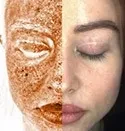 UV Damage