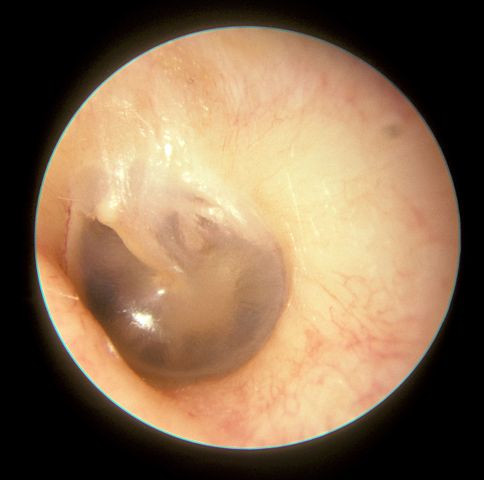 normal left eardrum