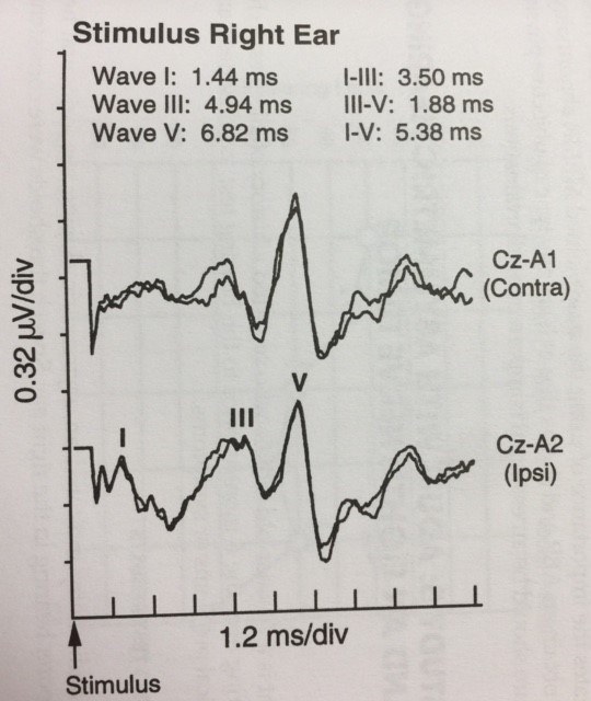 Stimulus chart of right ear analysis