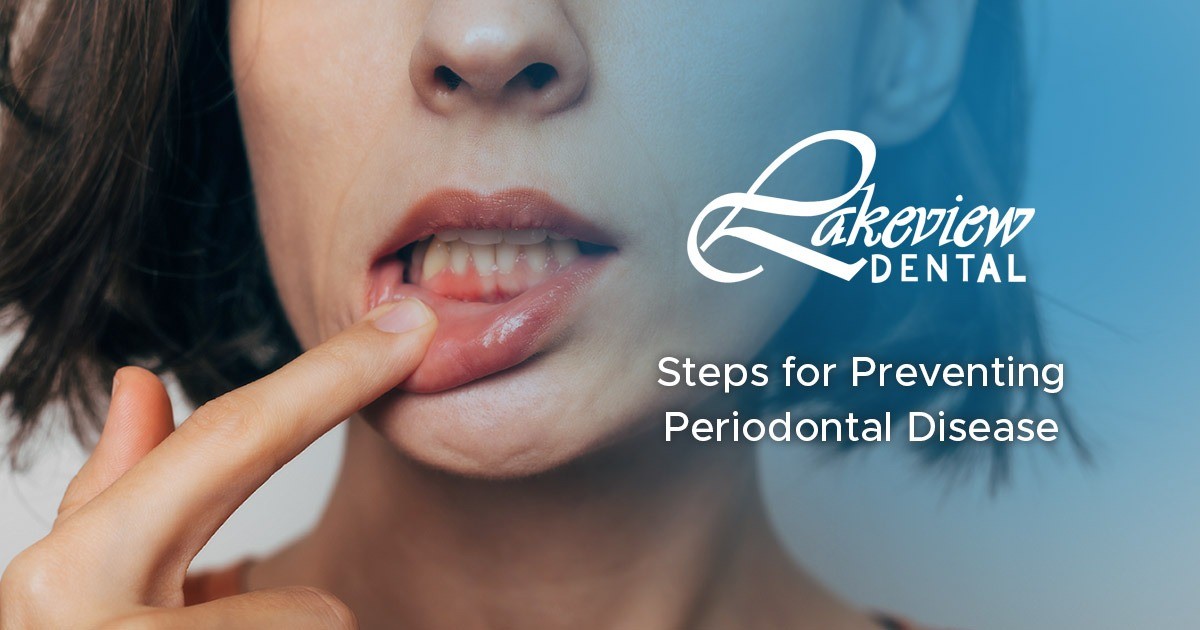 Steps for Preventing Periodontal Disease