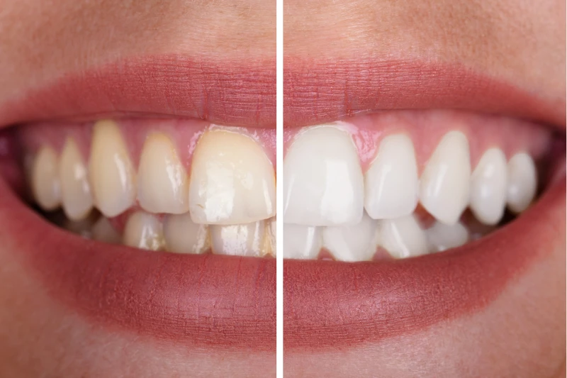 Close-up of a smile showing teeth before and after whitening, divided down the middle.