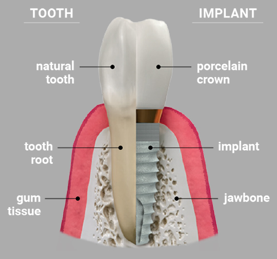 dental implant model