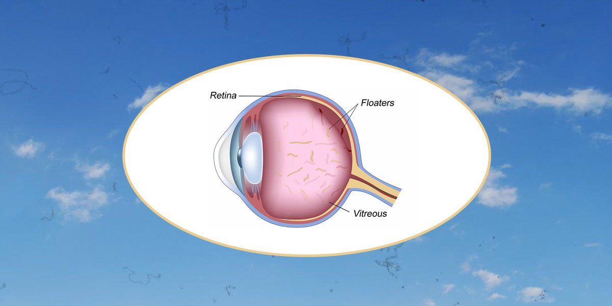 Are Eye Floaters And Flashes Normal